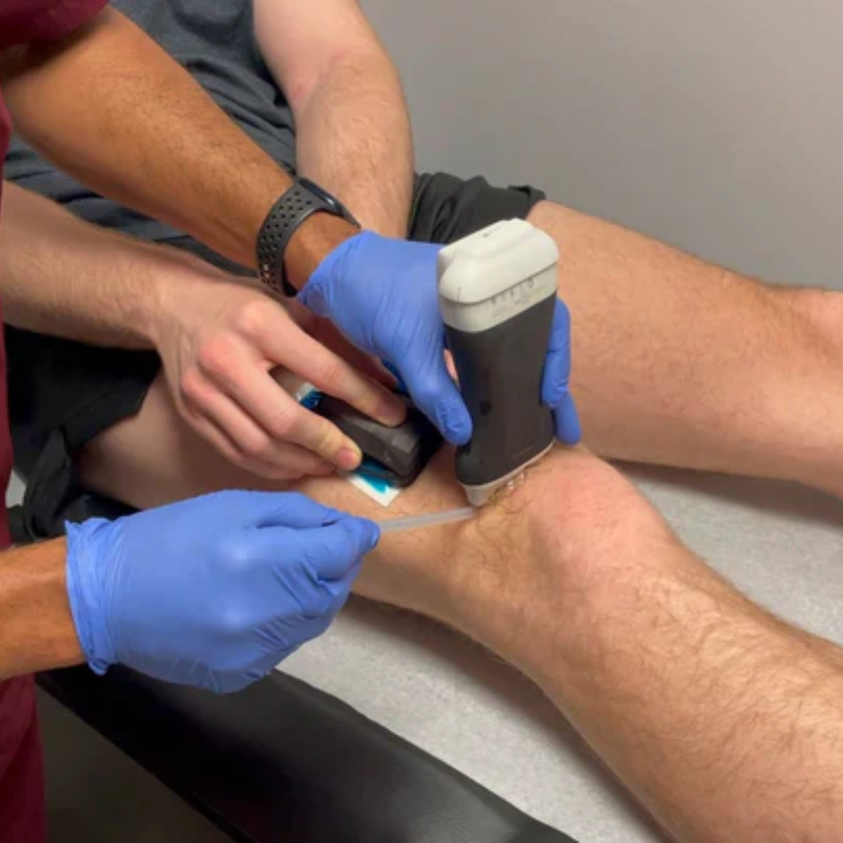 Buzzy Pro Needle Pain Relief Device for Dialysis and Blood Draws